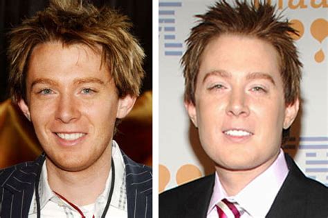 Clay Aiken Jaw Plastic Surgery Before And After Photos 2018 Plastic
