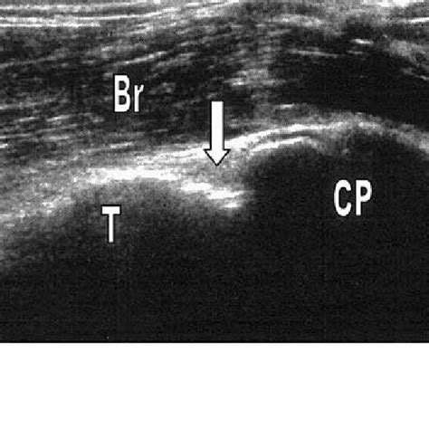 Torn Triceps Tendon Longitudinal Ultrasound Demonstrates Complete