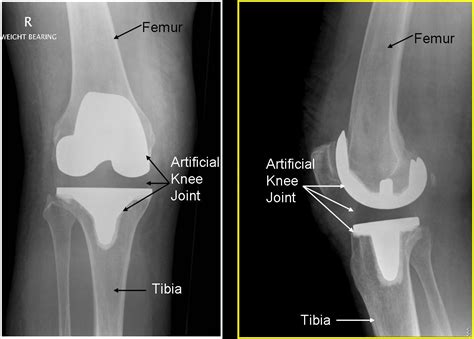 Total Knee Replacements Cardiff Hip And Knee Dr Sanjeev Agarwal