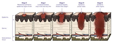 Stages Of Melanoma Mscan