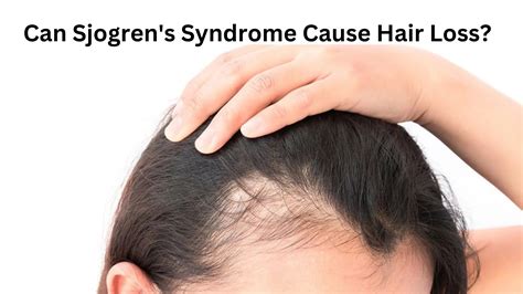 Can Sjogrens Syndrome Cause Hair Loss Baldgender
