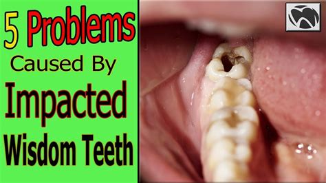 What Problems Can Impacted Wisdom Teeth Cause Teethwalls
