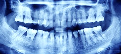 ¿qué Son Las Radiografías Dentales Y Cómo Se Interpretan