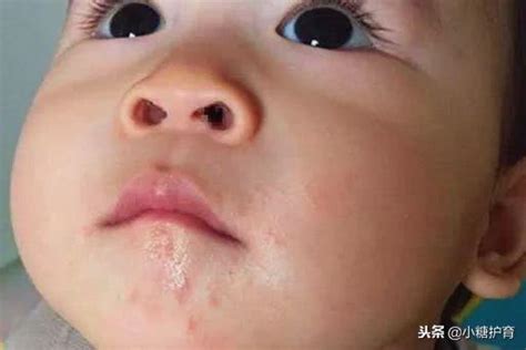 75宝宝都会经历口水疹，那究竟是什么原因造成？ 每日头条