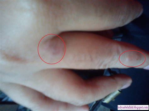 Bintik merah gatal menyebar di seluruh badan. Bahtera Life: Tangan & Muka Gatal-Gatal