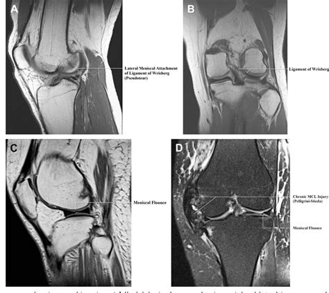 Figure 14 From Normal Mr Imaging Anatomy Of The Knee Semantic Scholar