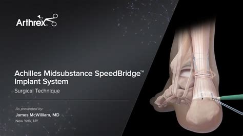 Arthrex Achilles Midsubstance Speedbridge Implant System