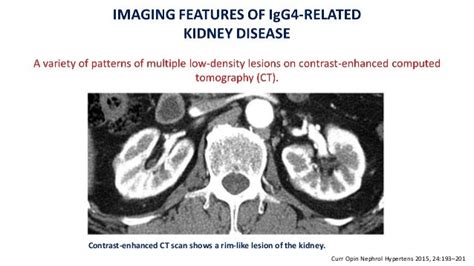 Igg4 Related Kidney Disease An Update
