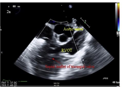 378 Multimodal Echocardiography Detection Of A Non Congenital Right