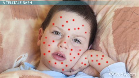 Chicken Pox Virus Structure And Function Lesson Study Com