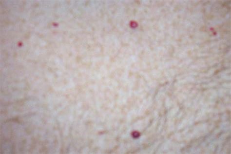 Raised Cherry Angioma On Scalp Online Dermatology Angioma They