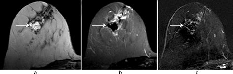 References In Mri Of Fat Necrosis Of The Breast The “black Hole” Sign