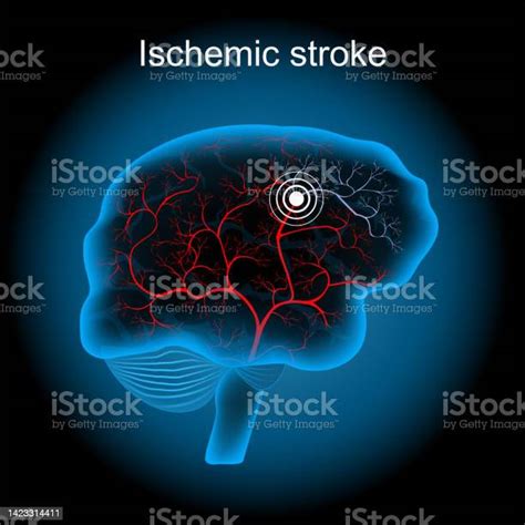 Cerebral Infarction Ischemic Stroke Human Brain Stock Illustration