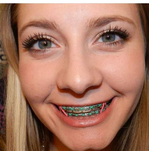 Stylish Braces Colors For A Trendy Smile