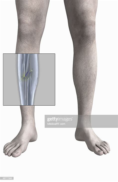 Anterior View Showing Fractures Of The Right Fibula And Tibia Stock