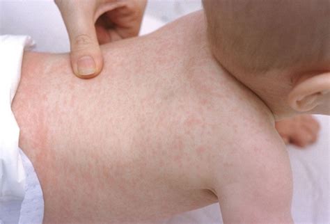 Roseola Rash A Viral Rash On The Skin Of A Child Stock Photo Download