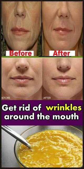 Get Rid Of Wrinkles Around The Mouth Face Wrinkles Mouth Healthy