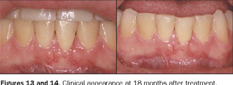 Figure 1 From Management Of Mandibular Anterior Teeth With Gingival