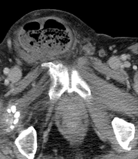 Axial Image The Right Inguinal Hernia Sac Containing Cecum Download