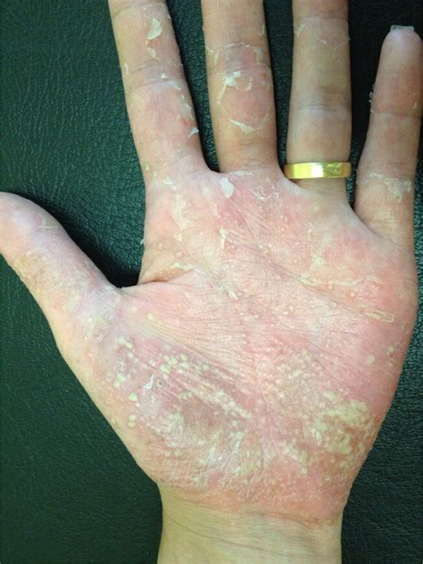 Erythema Multiple Pustules And Scaling In The Palmar Surface Of The
