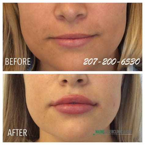 Juvederm Lip Filler Before After Maine Laser Clinic