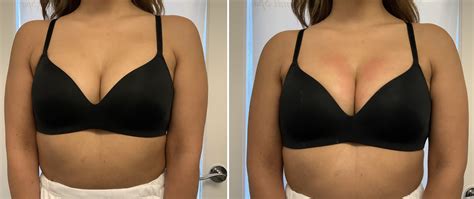 patient 65646387 vampire breast lift® before and after photos europhoria