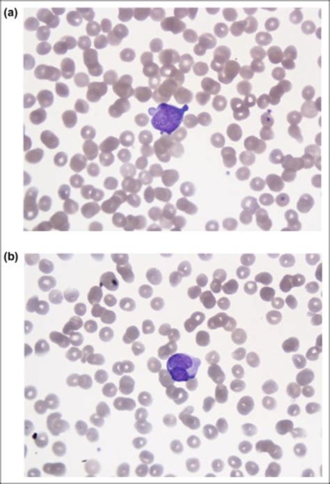 Peripheral Blood A The Majority Of Circulating Blasts Lacked Obvious