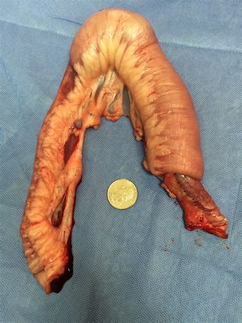 Also keep in mind that the hormonal changes do not happen overnight, delgado says. intussusception Archives | Dr Phil Zeltzman's Blog