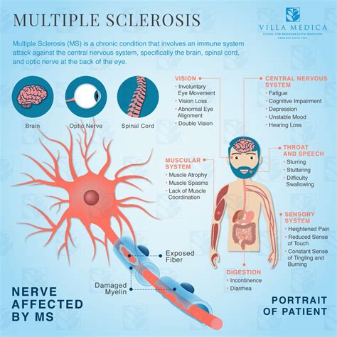 Official journal of the american neurological association and the child neurology society. Multiple Sclerosis infographic | Multiple sclerosis ...