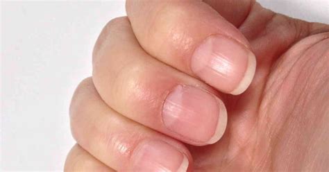 Iron Deficiency Anemia Nails