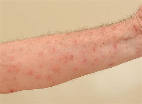 Scabies Skin Rash Pictures Causes Symptoms Home Remedy The Best Porn