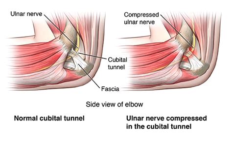 Ulnar Nerve Entrapment Physiophi Physiotherapy In Jindalee And Darra