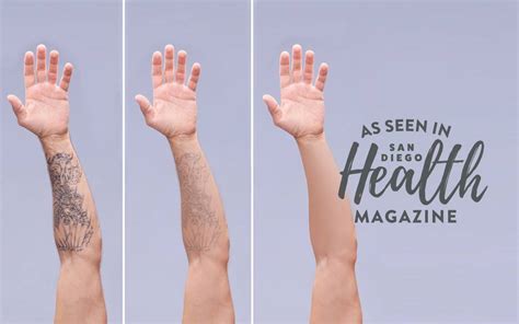 How Tattoo Removal Works Scripps Health