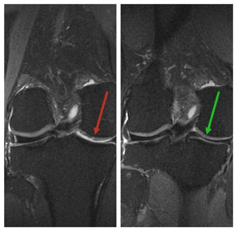 Magnetic Resonance Imaging Mri Status Of The Right Knee Joint Before