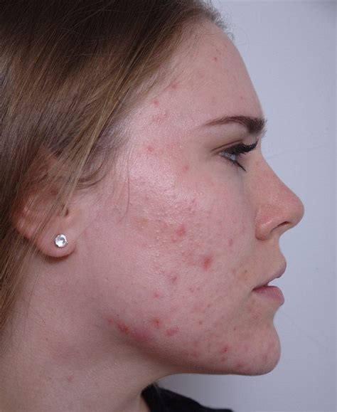 How To Beat An Acne Outbreak