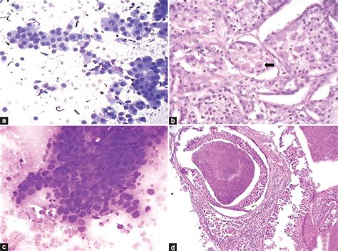 Fine Needle Aspiration Cytology In Diagnosis Of Salivary Gland Lesions