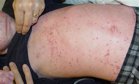 Eczema Medical Pictures Info Health Definitions Photos