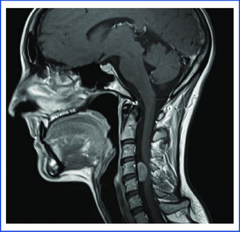 Sagittal T Mri Scan Of The Cervical Spine Showing That The Most
