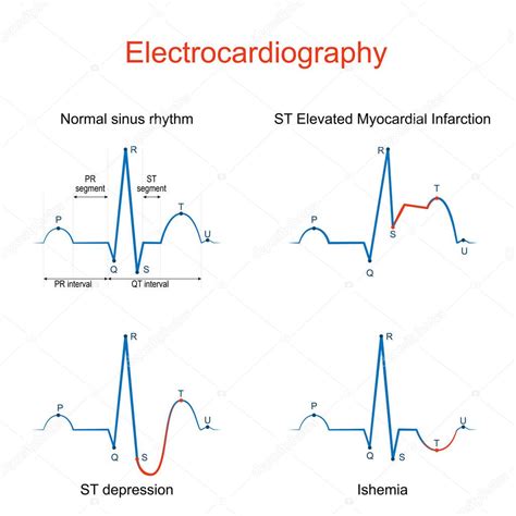Electrocardiografía ECG o ECG de un corazón con ritmo sinusal normal infarto de miocardio con