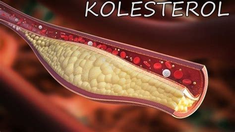 Mencari Tahu Tentang Adanya Tanda Tanda Kolesterol Tinggi Blog Kadek