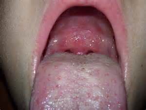 Ulcer On Roof Of Mouth Photos