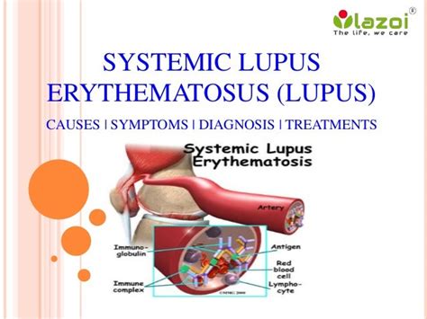 Systemic Lupus Erythematosus Lupus Disease Of The Immune System