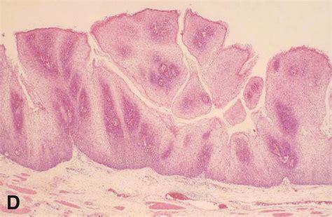 Giant Esophageal Papilloma Gastrointestinal Endoscopy