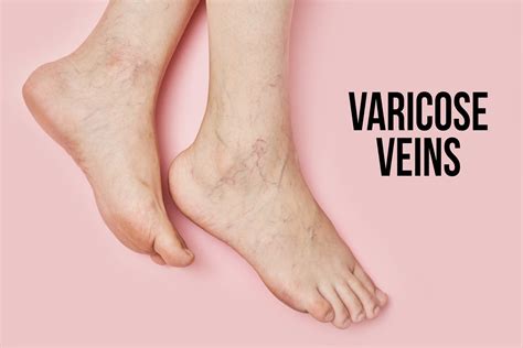 Female Feet Suffering From Varicose Veins Creative Commons Bilder
