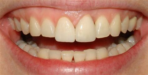 Dental Photos Before And After Dr Dove Dental Office