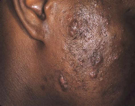 Skin Conditions That Cause Pimples