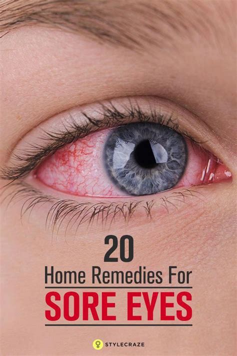 20 Effective Home Remedies For Sore Eyes Naturalhomeremedies Dry Eye