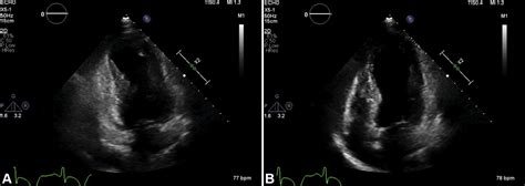 One Patient Three Variants Four Episodes Of Takotsubo Cardiomyopathy