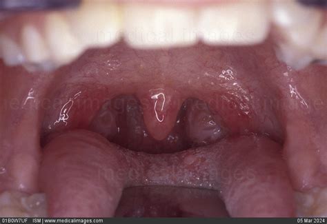 Stock Image Close Up Of Normal Tonsils 90495 01b0w7uf Ism Search