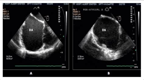 Figure 1 From Idiopathic Dilation Of The Right Atrium In Asymptomatic